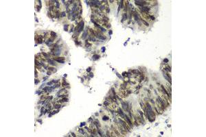 Immunohistochemistry of paraffin-embedded human colon carcinoma using TEAD1 antibody at dilution of 1:100 (x40 lens).