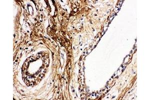 IHC-P: Protein C antibody testing of human breast cancer tissue (PROC 抗体  (AA 446-461))