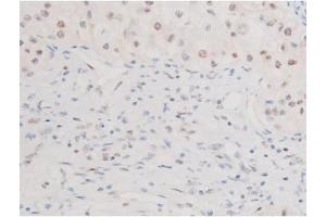 ABIN6267579 at 1/200 staining Human kidney cancer tissue sections by IHC-P. (FOXO4 抗体  (pSer197))