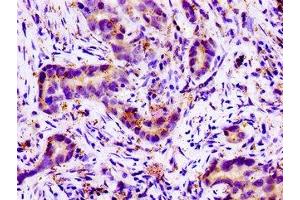 Immunohistochemistry of paraffin-embedded human pancreatic cancer using ABIN7161093 at dilution of 1:100 (SLC11A2 抗体  (AA 1-69))