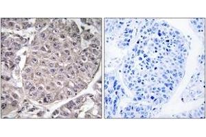 Immunohistochemistry analysis of paraffin-embedded human liver carcinoma tissue, using APOL4 Antibody. (Apolipoprotein L 4 抗体  (AA 301-350))