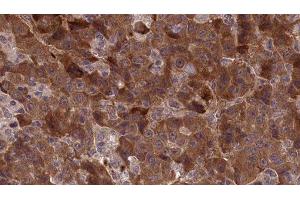 ABIN6277306 at 1/100 staining Human liver cancer tissue by IHC-P. (APLP1 抗体  (Internal Region))
