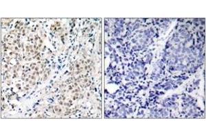 Immunohistochemistry analysis of paraffin-embedded human breast carcinoma tissue, using MYC (Ab-358) Antibody. (c-MYC 抗体  (AA 325-374))