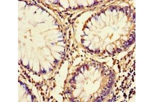 Immunohistochemistry of paraffin-embedded human colon cancer using ABIN7165430 at dilution of 1:100 (FAM161A 抗体  (AA 1-300))