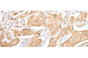 Immunohistochemistry of paraffin-embedded Human breast cancer tissue using GRAP Polyclonal Antibody at dilution of 1:40(x200) (GRAP 抗体)