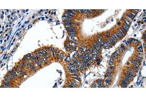 Immunohistochemistry of paraffin-embedded Human colon cancer using LAMA1 Polyclonal Antibody at dilution of 1:70 (Laminin alpha 1 抗体)