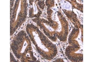 Immunohistochemistry of Human cervical cancer using MSH4 Polyclonal Antibody at dilution of 1:50 (MSH4 抗体)