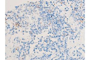 ABIN6255167 and ABIN6267222 at 1/100 staining rat cancer tissue sections by IHC-P. (CHEK1 抗体  (pSer286))