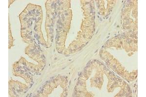 Immunohistochemistry of paraffin-embedded human prostate cancer using ABIN7165562 at dilution of 1:100 (FAM78A 抗体  (AA 21-283))