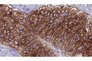 ABIN6275913 at 1/100 staining Human urothelial cancer tissue by IHC-P. (Adenosine A2a Receptor 抗体  (Internal Region))