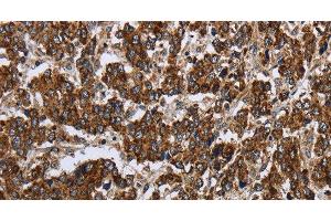 Immunohistochemistry of paraffin-embedded Human liver cancer using PPP1R13L Polyclonal Antibody at dilution of 1:30 (PPP1R13L 抗体)