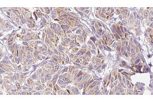 ABIN6277153 at 1/100 staining Human Melanoma tissue by IHC-P. (IL-10 抗体  (Internal Region))