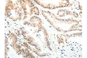 The image on the left is immunohistochemistry of paraffin-embedded Human colon cancer tissue using ABIN7189608(ABL2 Antibody) at dilution 1/25, on the right is treated with synthetic peptide. (ABL2 抗体)
