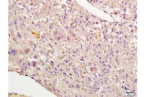 Formalin-fixed and paraffin embedded human endometrial cancer labeled with Rabbit Anti-Nrf2 Polyclonal Antibody, Unconjugated (ABIN737271) 1:200 followed by conjugation to the secondary antibody and DAB staining (NRF2 抗体  (AA 430-480))