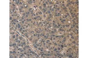 Immunohistochemistry of Human liver cancer using DRG1 Polyclonal Antibody at dilution of 1:30 (DRG1 抗体)
