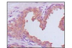 Immunohistochemical analysis of paraffin-embedded human prostate carcinoma tissues, showing cytoplasmic localization using KLK3 mouse mAb with DAB staining. (Prostate Specific Antigen 抗体  (AA 26-251))