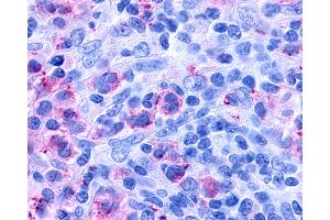 Anti-CYSLTR1 / CYSLT1 antibody IHC of human Lymph Node, Hodgkins Lymphoma. (CysLTR1 抗体  (Extracellular Domain))