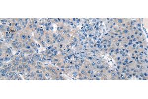 Immunohistochemistry of paraffin-embedded Human liver cancer tissue using CITED4 Polyclonal Antibody at dilution of 1:65(x200) (CITED4 抗体)