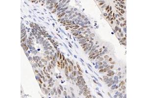 Immunohistochemistry analysis of paraffin-embedded human colon cancer using ADRA1B (ABIN7072974) at dilution of 1: 1200
