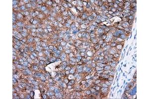Immunohistochemical staining of paraffin-embedded Adenocarcinoma of colon tissue using anti-PRKAR2A mouse monoclonal antibody. (PRKAR2A 抗体)