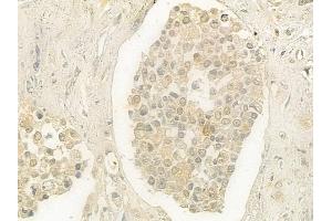 ABIN6264446 and ABIN6277606 at 1/100 staining human prostate carcinoma by IHC-P.