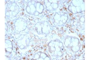 Formalin-fixed, paraffin-embedded human Colon Carcinoma stained with CD209 Mouse Monoclonal Antibody (rC209/1781). (Recombinant DC-SIGN/CD209 抗体)