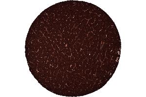 Pancreatic neuroendocrine tumor Insulinoma with strong C peptide staining of all tumor cells