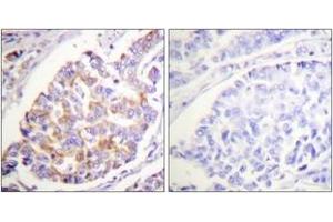 Immunohistochemistry analysis of paraffin-embedded human breast carcinoma, using ADD1 (Phospho-Ser726) Antibody. (alpha Adducin 抗体  (pSer726))