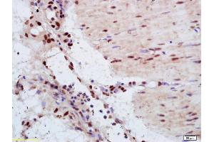 Formalin-fixed and paraffin embedded human gastric carcinoma labeled with Anti-YAP1 Polyclonal Antibody, Unconjugated (ABIN701485) at 1:200 followed by conjugation to the secondary antibody and DAB staining. (YAP1 抗体  (AA 131-330))