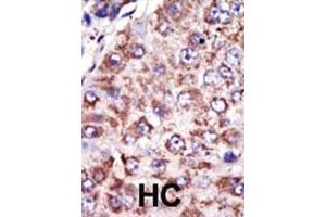 Formalin-fixed and paraffin-embedded human cancer tissue reacted with the primary antibody, which was peroxidase-conjugated to the secondary antibody, followed by DAB staining. (FDFT1 抗体  (N-Term))