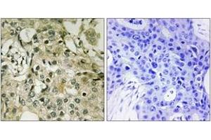 Immunohistochemistry analysis of paraffin-embedded human breast carcinoma tissue, using DTYMK Antibody. (DTYMK 抗体  (AA 1-50))