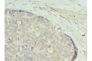 Immunohistochemistry of paraffin-embedded human gastric cancer using ABIN7166707 at dilution of 1:100