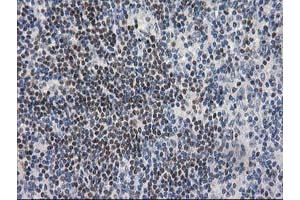 Immunohistochemical staining of paraffin-embedded Human lymphoma tissue using anti-ARFGAP1 mouse monoclonal antibody. (ARFGAP1 抗体)