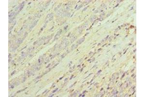 Immunohistochemistry of paraffin-embedded human colon cancer using ABIN7143694 at dilution of 1:100