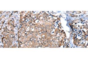 Immunohistochemistry of paraffin-embedded Human breast cancer tissue using WFDC5 Polyclonal Antibody at dilution of 1:60(x200) (WFDC5 抗体)
