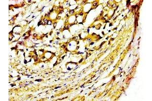 IHC image of ABIN7155047 diluted at 1:400 and staining in paraffin-embedded human gastric cancer performed on a Leica BondTM system. (MST1 抗体  (AA 363-465))