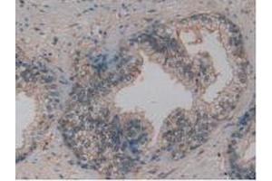 IHC-P analysis of Human Prostate Gland Cancer Tissue, with DAB staining. (Osteopontin 抗体  (AA 17-287))