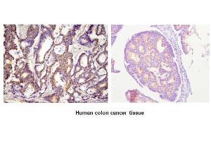 Paraffin embedded sections of human colon canitrocelluloseer tissue were initrocelluloseubated with anti-human ACOT11 (1:100) for 2 hours at room temperature. (ACOT11 抗体  (AA 19-250))