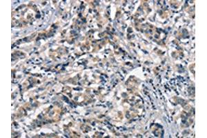 The image on the left is immunohistochemistry of paraffin-embedded Human breast cancer tissue using ABIN7189845(APOA1BP Antibody) at dilution 1/15, on the right is treated with synthetic peptide. (APOA1BP 抗体)
