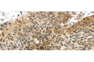 Immunohistochemistry of paraffin-embedded Human esophagus cancer tissue using TTBK2 Polyclonal Antibody at dilution 1:45 (TTBK2 抗体)