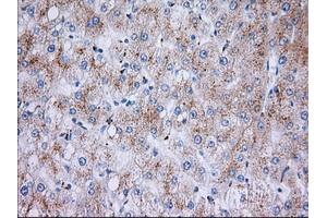 Immunohistochemical staining of paraffin-embedded Carcinoma of Human liver tissue using anti-RAB17 mouse monoclonal antibody. (RAB17 抗体)