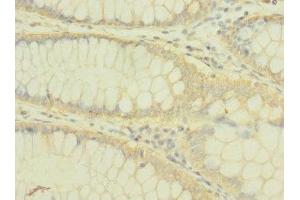 Immunohistochemistry of paraffin-embedded human colon cancer using ABIN7163708 at dilution of 1:100 (Plexin B2 抗体  (AA 1080-1200))