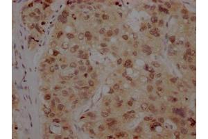 IHC image of ABIN7127369 diluted at 1:100 and staining in paraffin-embedded human liver cancer performed on a Leica BondTM system. (Recombinant BMI1 抗体)