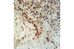Formalin fixed, paraffin embedded human lung carcinoma stained with Artemis Antibody (N-term) followed by peroxidase conjugation of the secondary antibody and DAB staining. (DCLRE1C 抗体  (N-Term))