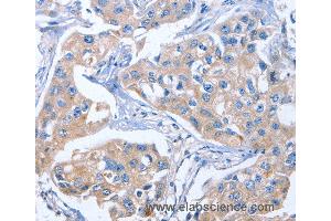 Immunohistochemistry of Human colon cancer using IBSP Polyclonal Antibody at dilution of 1:50 (IBSP 抗体)