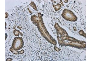 The image on the left is immunohistochemistry of paraffin-embedded Human colorectal cancer tissue using ABIN7191486(MMP24 Antibody) at dilution 1/25, on the right is treated with synthetic peptide. (MMP24 抗体)