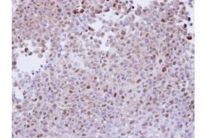 IHC-P Image Immunohistochemical analysis of paraffin-embedded CL1-5 xenograft, using proteasome alpha 7, antibody at 1:100 dilution. (PSMA7 抗体  (Center))