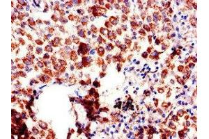 Immunohistochemistry of paraffin-embedded human lung cancer using ABIN7144520 at dilution of 1:100 (AQP6 抗体  (AA 1-30))