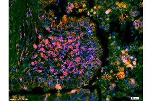 Formalin-fixed and paraffin embedded human lung carcinoma labeled with Anti-phospho-ERK1/2(Thr202 + Tyr204) Polyclonal Antibody, Unconjugated (ABIN682933) at 1:200 followed by conjugation to the secondary antibody Goat Anti-Rabbit IgG, Cy3 conjugated used at 1:200 dilution for 40 minutes at 37°C and DAPI staining (ERK1/2 抗体  (pThr202, pTyr204))