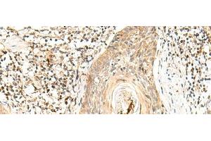 Immunohistochemistry of paraffin-embedded Human esophagus cancer tissue using POLR1E Polyclonal Antibody at dilution of 1:40(x200) (POLR1E 抗体)